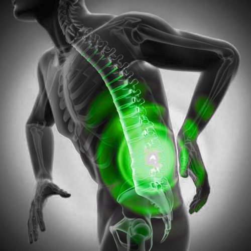 Lumbar-Disc-Herniation g دیسک کمر؛ چه کسانی واقعاً نیاز به جراحی دارند؟