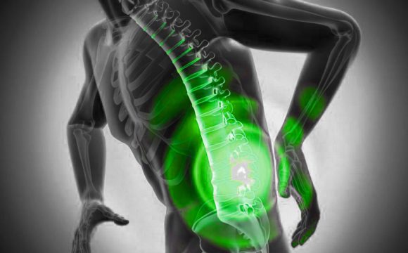 Lumbar-Disc-Herniation g دیسک کمر؛ چه کسانی واقعاً نیاز به جراحی دارند؟