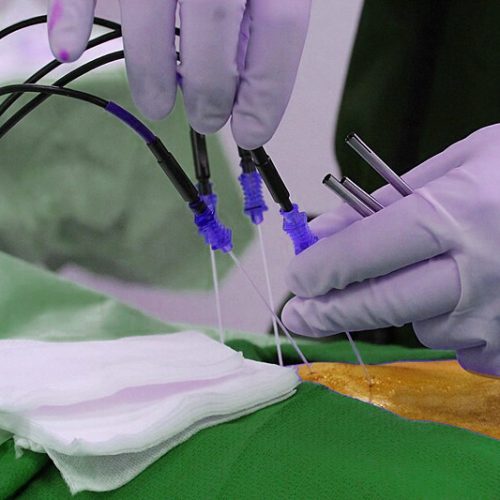 Radiofrequency Ablation (RFA) رادیوفروکونسی و لیزر اعصاب فوق تخصص درد