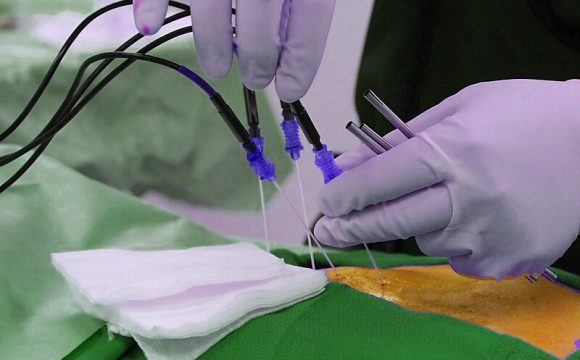 Radiofrequency Ablation (RFA) رادیوفروکونسی و لیزر اعصاب فوق تخصص درد