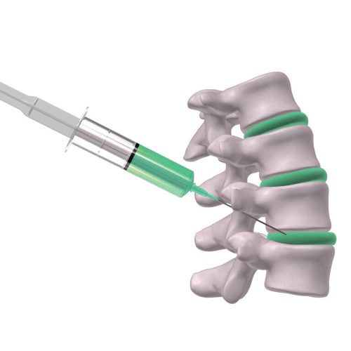 Intradiscal Treatments انواع درمان های داخل دیسک
