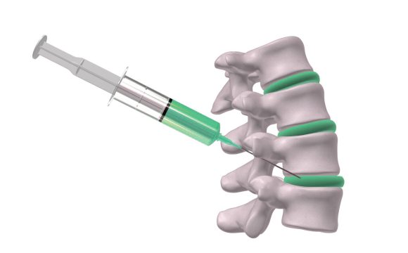 Intradiscal Treatments انواع درمان های داخل دیسک